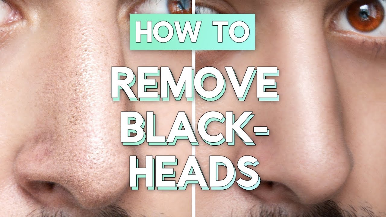 how to remove blackheads from nose
